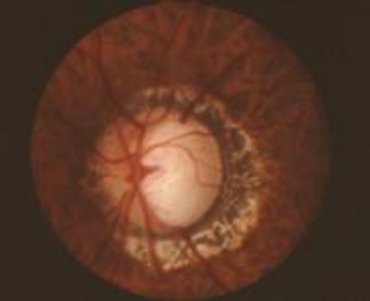 Image of Advanced Glaucoma