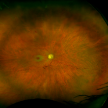 Eye image of cherry red spot from central retinal artery occlusion 