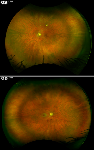 Normal Eye vs Eye with Cherry Red Spot