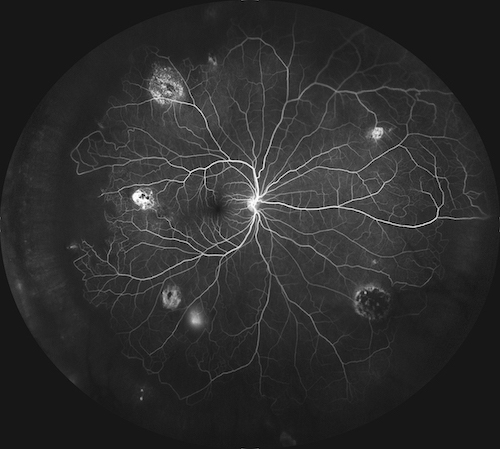 Third Place in the Fluorescein Angiography Category: Sickle Cell Retinopathy 