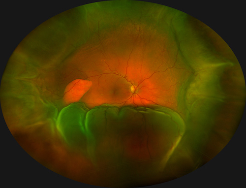 Honorable Mention in Ultra-Widefield Imaging: Choroidal Detachment with Retinal Tear 
