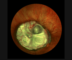 california_coloboma_uwf