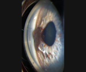 haag-streit_iris_lesion_gonio