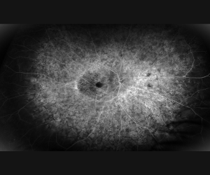 presumed_retinal_dystrophy_fa