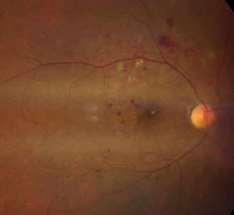 Endocrinology-Based Screening Uncovers Advanced Diabetic Retinopathy on a Previously Undiagnosed Patient 