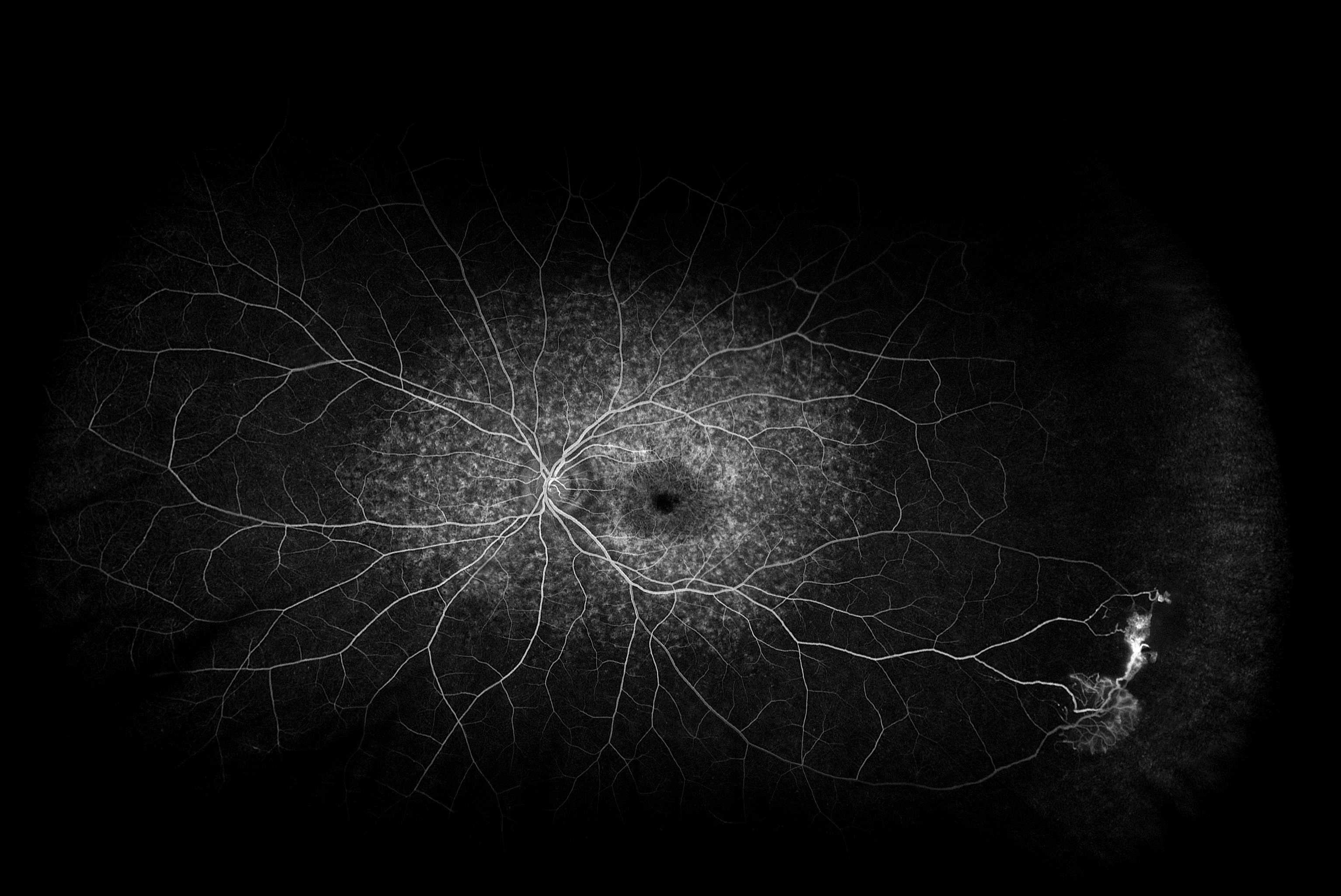 Becky photo of macular pattern dystrophy