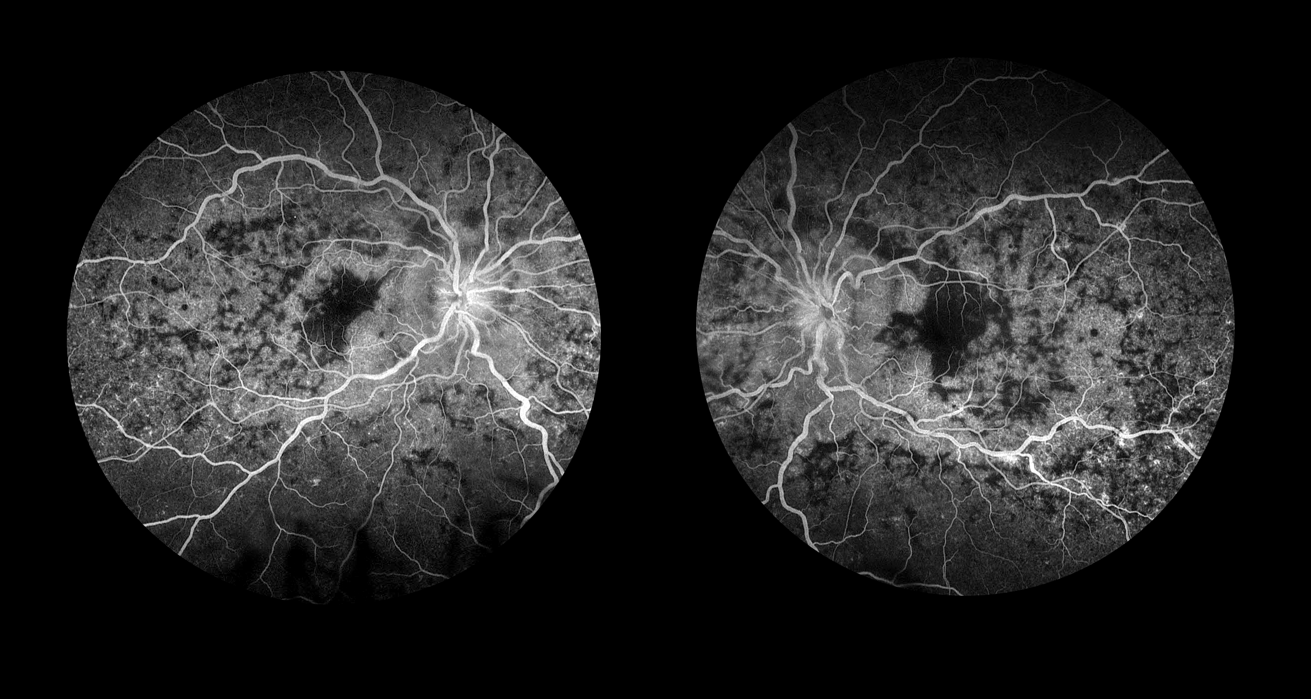 Becky photo of panuveitis