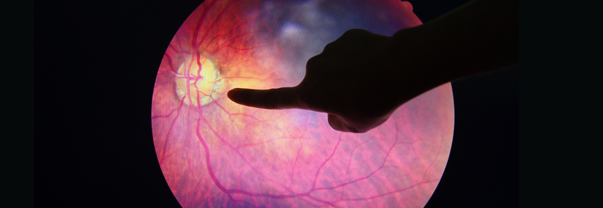 eye image of retinal detachment