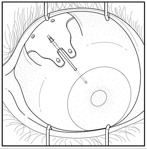 From the filed patent, a drawing excerpt showcasing an implant on the plate side of the GDD temporarily sealing the tube.