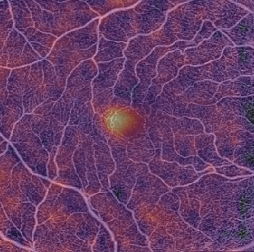 OCT angiography