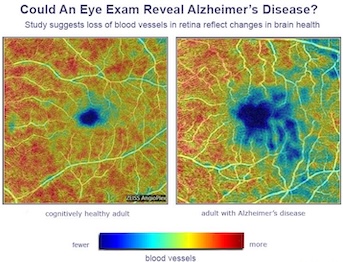 eye images showing retinal differences between a set of twins - one cognitive healthy and cognitive impaired adult