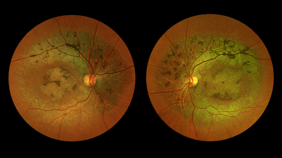 Optos California Inherited Retinal Disease image