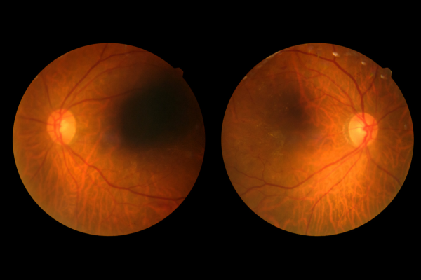 Diabetic Retinopathy 