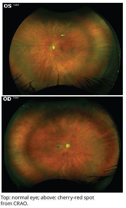 first-of-its-kind-program-to-improve-care-for-eye-stroke-duke