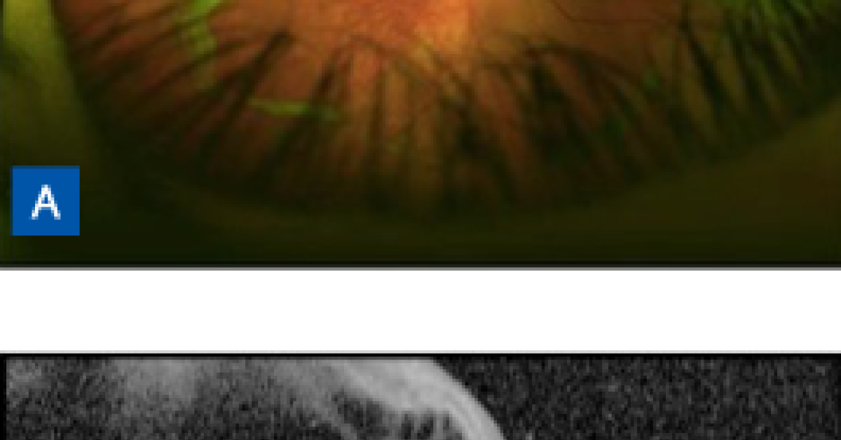 Clinical Practice Today Quick Case Blurry Vision in a Young Patient