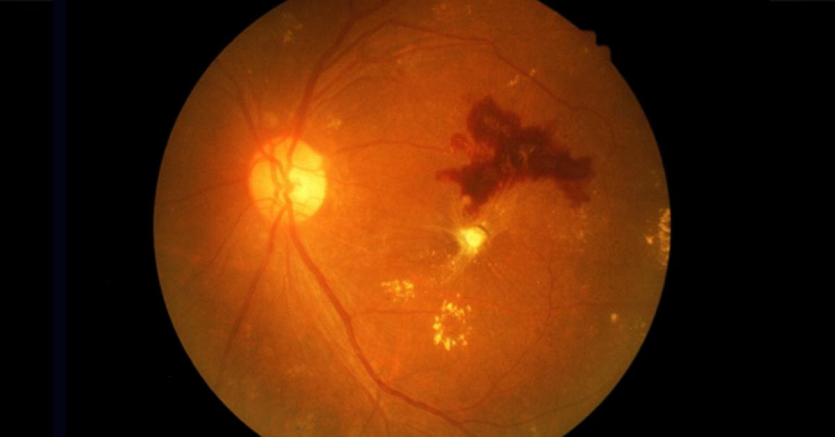 A New Model for Diabetic Retinopathy Screening and Triage | Duke ...