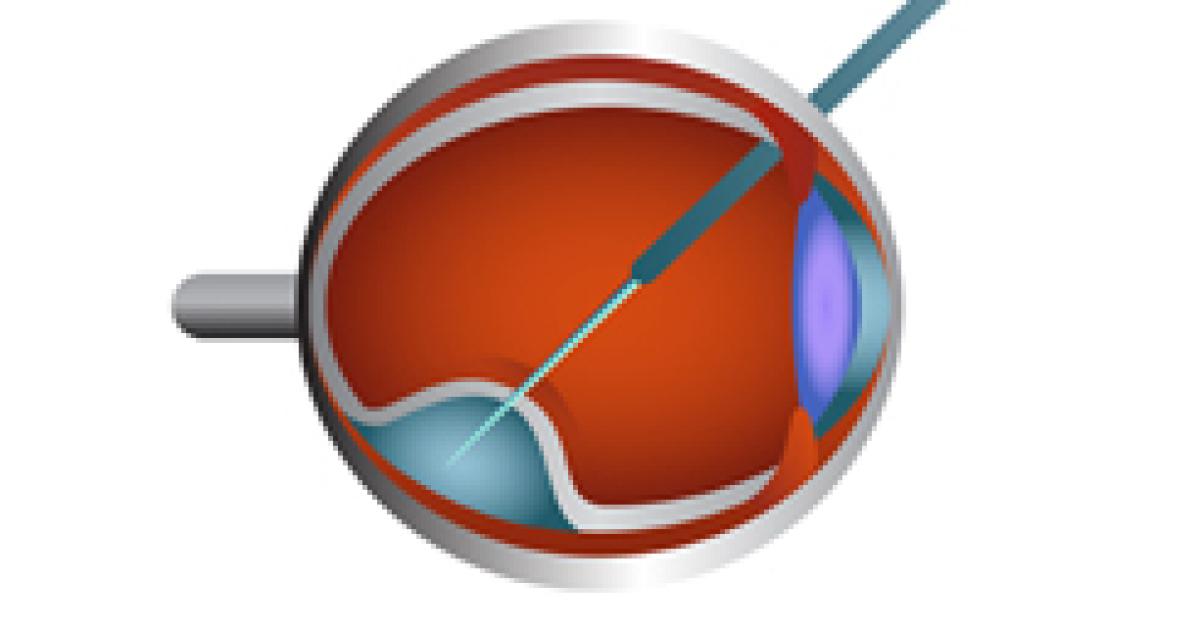 Clinical Practice Today MIOCT Facilitates Accurate Measurement of